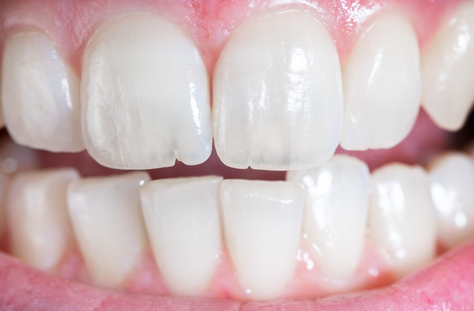 how to fix a cracked tooth naturally​