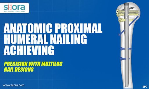 Anatomic Proximal Humeral Nailing: Achieving Precision with Multiloc Nail Designs